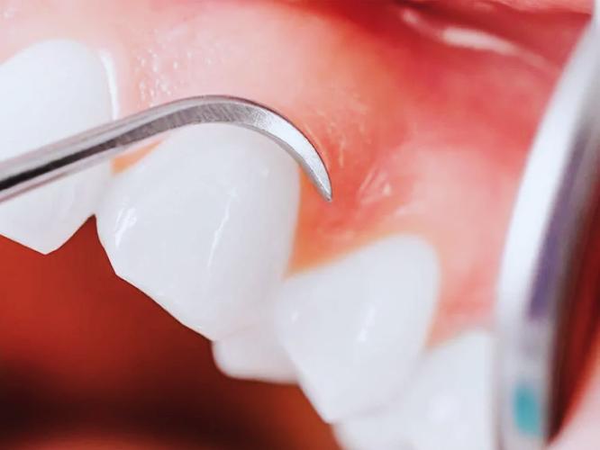 마곡역치과_ 1. 스케일링 꼭 받아야 하나요? 치석 제거부터 잇몸병 예방까지 효과 총정리 관련 이미지 3