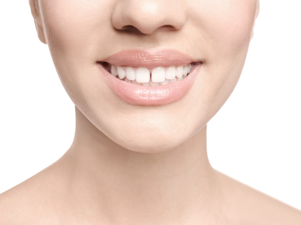 마곡치과_  1. 무삭제 라미네이트가 가능한 경우 ( feat. 디아네이트) 관련 이미지 5