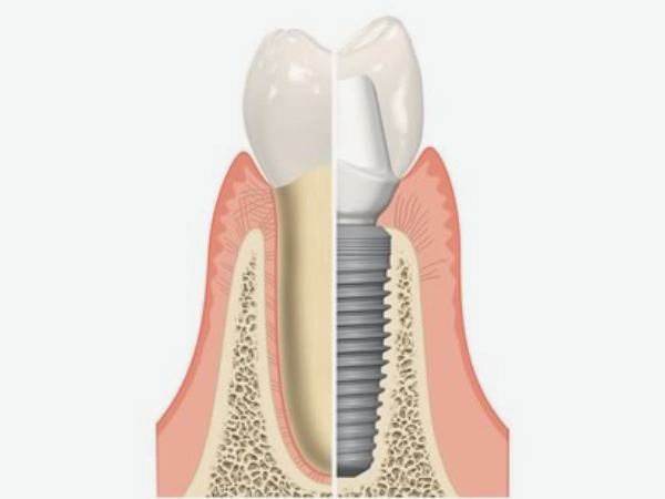 [ 마곡동치과_치아 상실 3 ] 이빨 빠지면 임플란트? 장점과 시기 쉽게 정리했습니다 관련 이미지 3