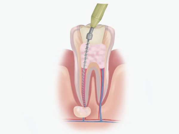 마곡치과_1. 재신경치료 필요한 이유, 신경치료 후 통증 왜 다시 아플까요? 관련 이미지 4