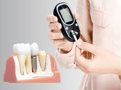 Magok-dong Dental Clinic_3. 6 Must-Check Points Before Full-Mouth Implant Surgery image 1