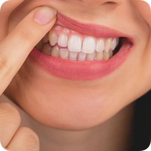 마곡역치과_5. 인레이 보철물 떨어지는 이유 [ 탈락 원인과 재접착 가능한 경우는? ] 관련 이미지 7