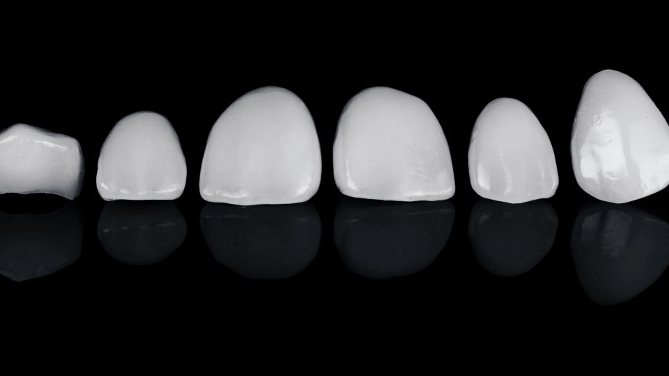 마곡동치과_2. 무삭제 라미네이트가 불가능한 경우 관련 이미지 6