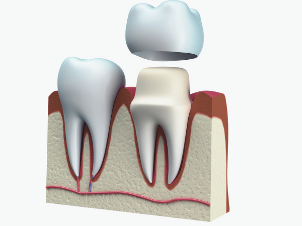 마곡역치과_3. 치아 보호를 위한 크라운 보철 치료 과정 관련 이미지 5