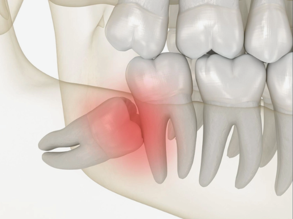 마곡동치과_1. 사랑니, 가장 늦게 가장 깊이 나는 치아? 위치와 맹출 시기 총정리 관련 이미지 4