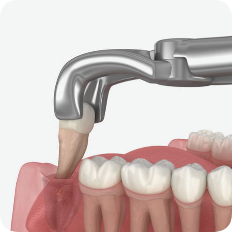 마곡동치과_10. 사랑니 발치 비용, 진짜 얼마일까요? 건강보험 적용으로 부담 덜어드립니다! 관련 이미지 1