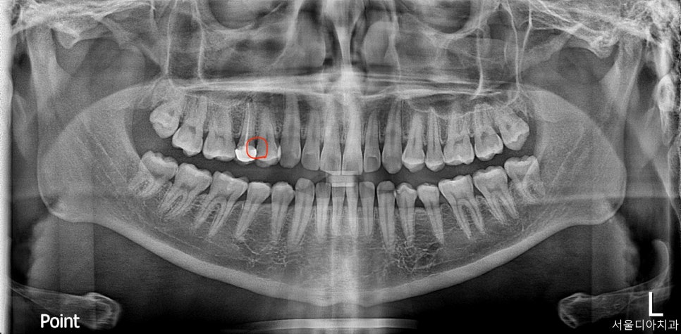 마곡동치과_당일 인레이 치료 과정 관련 이미지 3
