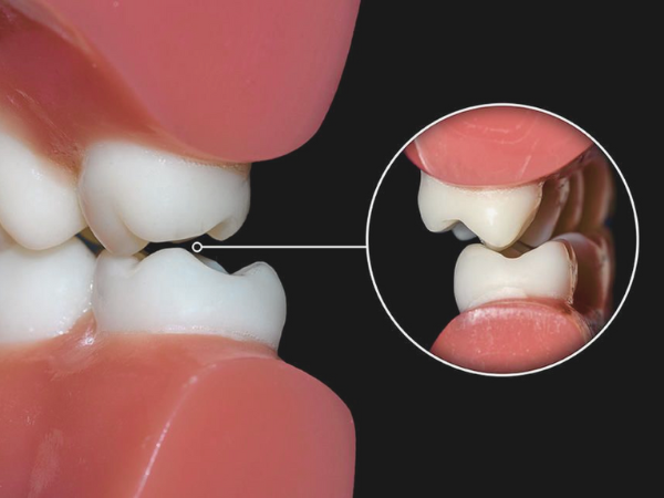 마곡역치과_4. 인레이 치료 후 통증 생기는 이유 [ 자연스러운 회복? 문제 신호?] 관련 이미지 2
