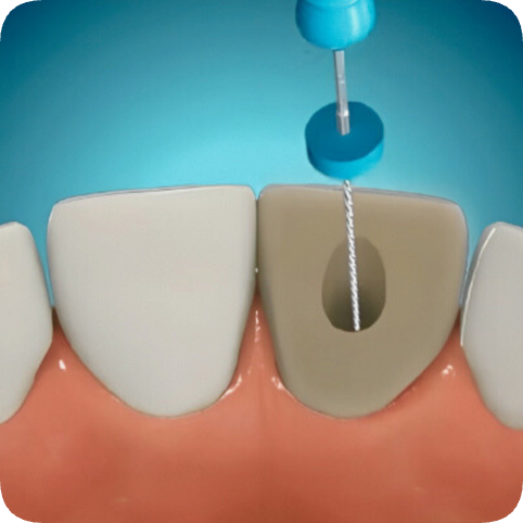 마곡역치과_ 신경이 죽은 치아를 다시 하얗게! [ 2. 실활치 미백&rsquo;의 원리와 과정 ] 관련 이미지 4
