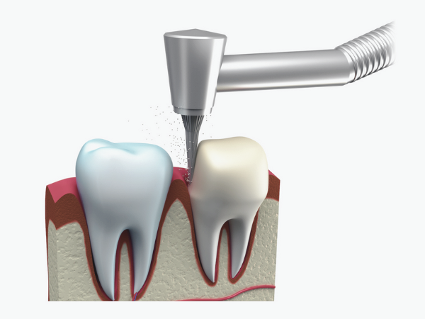 마곡역치과_3. 치아 보호를 위한 크라운 보철 치료 과정 관련 이미지 3
