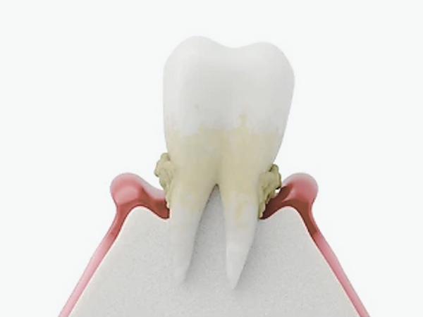 Maggok Dental_1. “If Your Gums Bleed When You Brush Your Teeth?” Early Symptoms of Gingivitis and Self-Check Method image 3