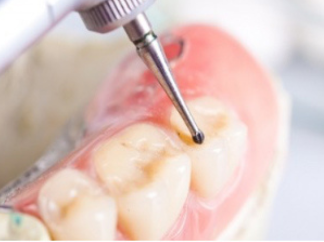 마곡역치과_4. 인레이 치료 후 통증 생기는 이유 [ 자연스러운 회복? 문제 신호?] 관련 이미지 1