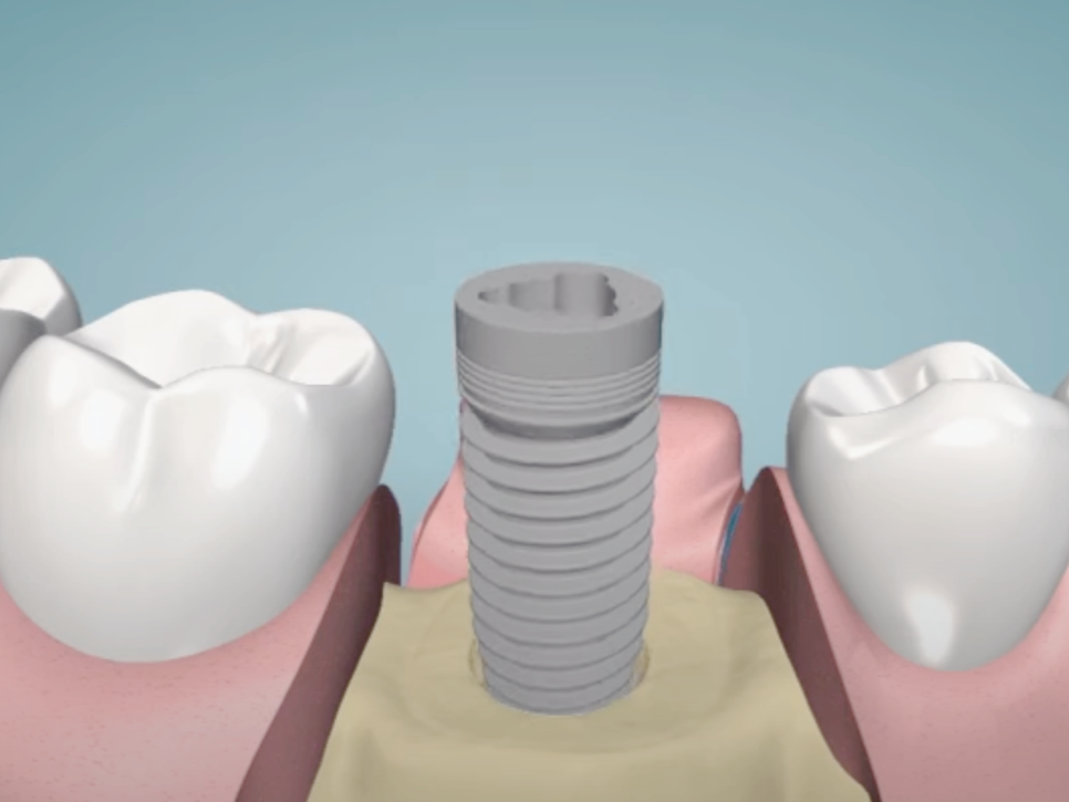 마곡역치과_"씹는 즐거움, 웃는 자신감, 내 이 같은 자연스러움" [ 3. 임플란트 수술과정 ] 관련 이미지 3