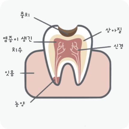 마곡동치과_ "치아 속 구조 복원 프로젝트" [2. 신경치료 단계별 진행 과정 ] 관련 이미지 1
