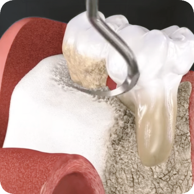Maggok Dental_3. Gum Surgery: When Periodontal Flap Surgery Is Needed and the Treatment Process image 5