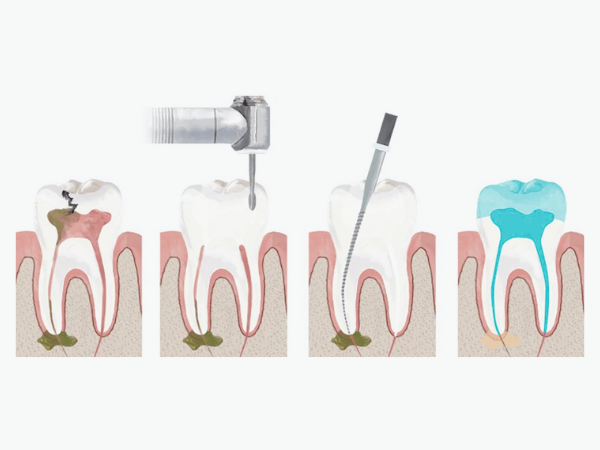 마곡역치과_ &ldquo;참으면 더 커지는 통증?&rdquo; [2. 치수염 치료] 관련 이미지 2