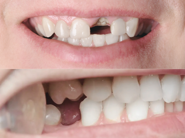 마곡동치과_ "이를 뽑은 날 바로 심을 수 있을까" [ 1. 당일 임플란트 조건 ] 관련 이미지 5