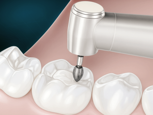 마곡역치과_&ldquo;치아는 살리고 충치만 잡는다" [ 어금니 레진 치료 과정 ] 관련 이미지 7