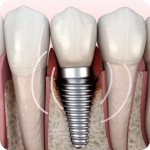 마곡동치과_" 임플란트, 오래 쓰는 가장 똑똑한 관리법"[ 6. 임플란트 보철 후  관리 팁 ] 관련 이미지 2