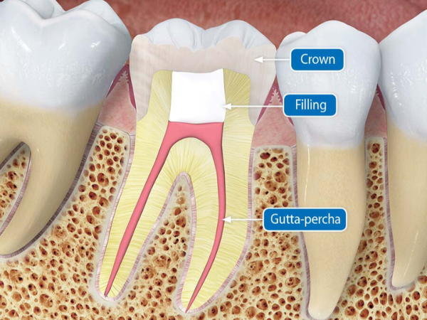 마곡역치과_&ldquo;이가 닳았다면 이렇게 해결하세요!&rdquo; [5. 치아마모 치료] 관련 이미지 3