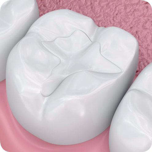 마곡치과_&ldquo;레진의 매력, 알면 선택이 쉬워집니다&rdquo; [ 2. 레진의 장,단점과 비용 ] 관련 이미지 1