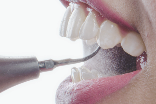 마곡치과_"통증은 줄이고, 상쾌함은 더하다!" [ 1. 에어플로우 스케일링의 원리와 특징 ] 관련 이미지 6