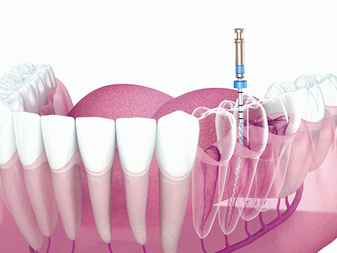 마곡역치과_ &ldquo;참지 말고 잡자!&rdquo; [ 2. 시린이(지각과민증) 치료 ] 관련 이미지 6