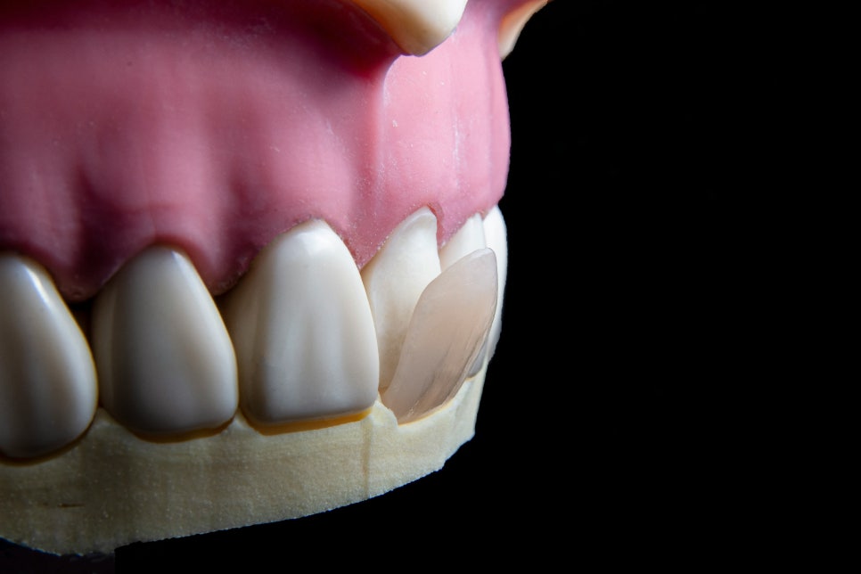 [ Magok Veneers_07 ] Veneer Failure Cases: Be Careful in These Situations image 3