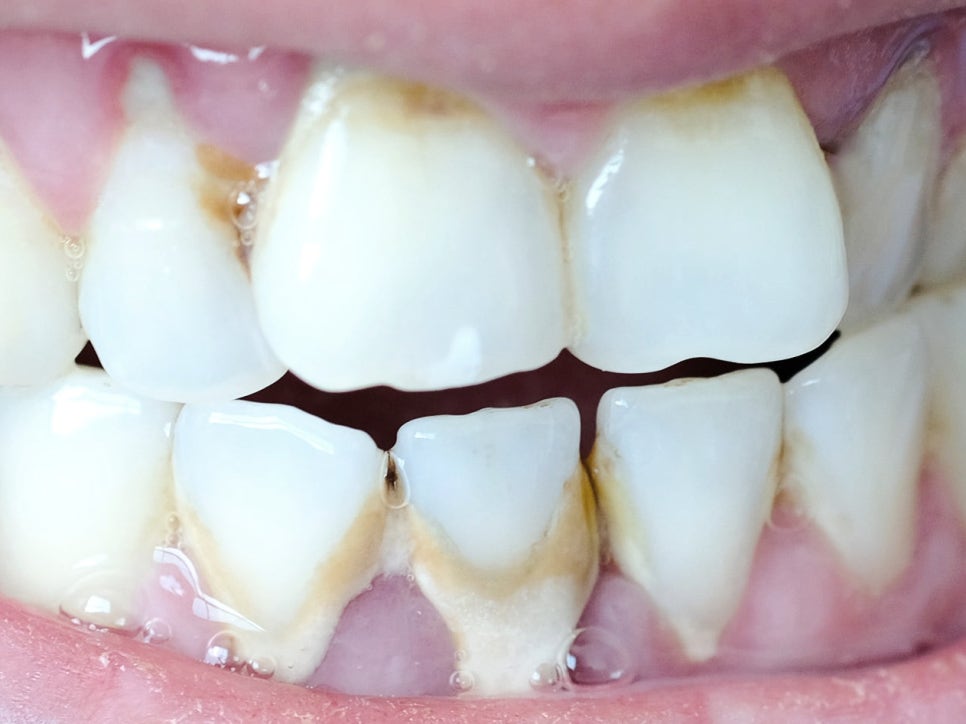 마곡동치과_ 2. 스케일링 주기와 소요 시간, 내 입속 상황에 맞게 꼭 알아야 할 포인트! 관련 이미지 2