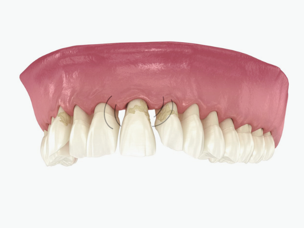 마곡역치과_6. 중장년기(50~60대) 구강 변화와 치아 상실 예방 관리법 관련 이미지 1