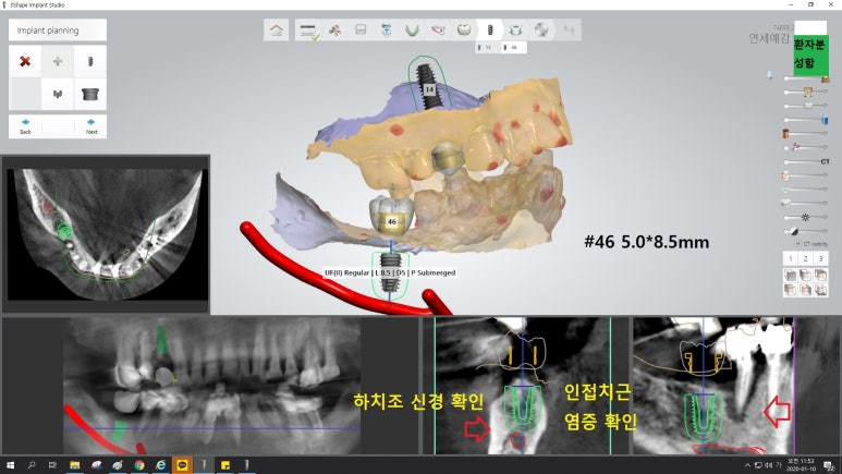 [광화문임플란트]임플란트 많이 아픈가요? 겁이 많아요 -네비게이션 임플란트 사례 관련 이미지 3