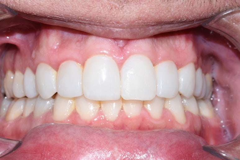 [시청역/서울역 치과] 앞니 치아부러짐 자연스럽게 치료사례 관련 이미지 5