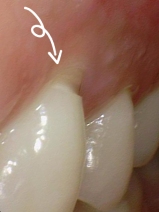 남대문치과 치아가 시리다면? 잇몸패임인가요? 관련 이미지 3