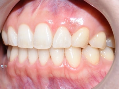 (교정 후에도) 벌어진 앞니 치아 레진으로 간단히 메꾸기 관련 이미지 6