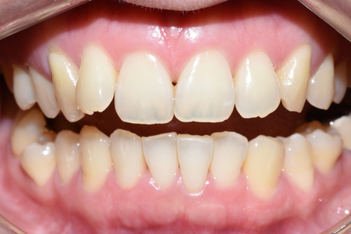 [시청역/광화문/서대문]삐뚤삐뚤한 치아 무삭제라미네이트로 치아성형 관련 이미지 9