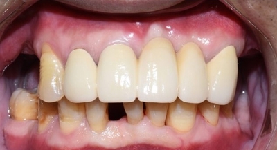 [치과브릿지케이스] 앞니가 너무 많이 흔들려서 발치해야 할 것 같아요 관련 이미지 5