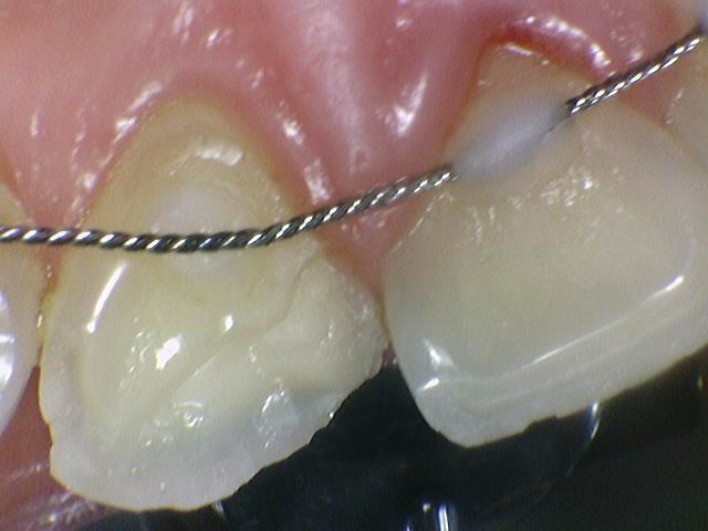 라미네이트 2개이상시 개당 50만원(부가세별도) 깨진 앞니 최소삭제한 라미네이트 케이스 관련 이미지 4