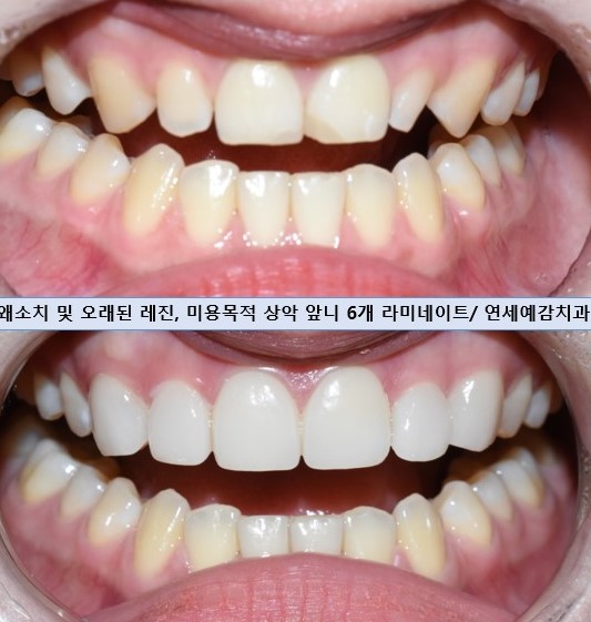 무삭제 라미네이트 치료로 자연스럽게! 왜소치+오래된 앞니레진까지 개선한 케이스 관련 이미지 2