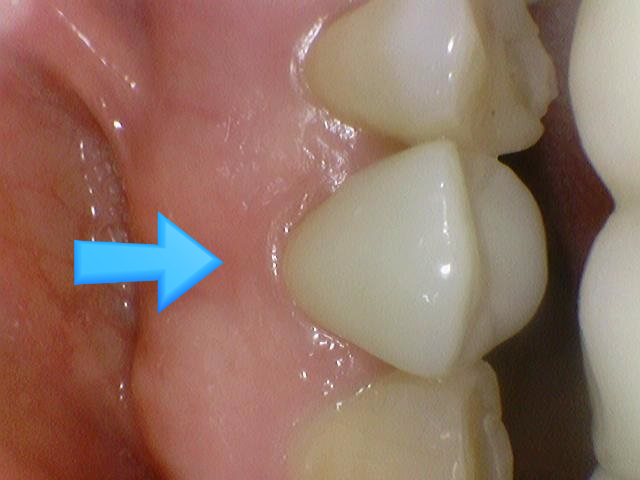 치아가 충치나 크랙으로 지르코니아 크라운을 해야한다면? 구강스캔사용치과의 지르코니아크라운 설명 관련 이미지 6
