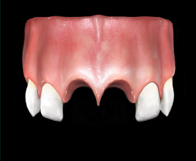 넘어져서 또는 부딪혀서 앞니 아주 많이 부러진 경우, 시청역치과 실제 앞니브릿지케이스 관련 이미지 5