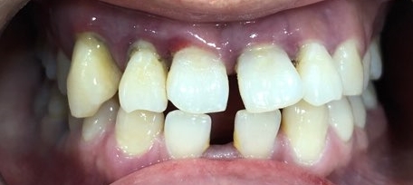 시청역치과 벌어진 앞니를 바르고 이쁘게! 대한심미학회회원치과 관련 이미지 12