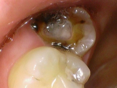 시청역치과 객관적인 근거로 치료하며, 환자분께 치료 전 치료해야하는 이유를 보여드립니다. 관련 이미지 8
