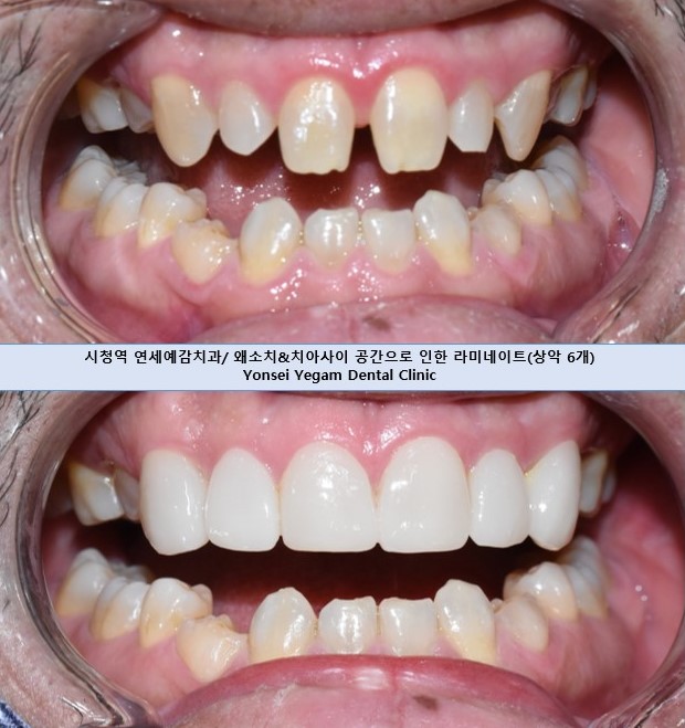앞니전문으로 외국인들이 찾아오는 연세예감치과에서 알려 드리는 하나만 변색된 앞니의 크라운치료 관련 이미지 5