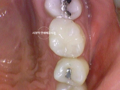 시청역 충정로 충치치료 치과 추천 관련 이미지 8