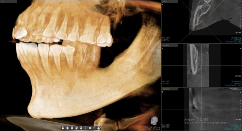 충정로 서울역 근처 고난도 & 재수술 임플란트 수술 치과 관련 이미지 10