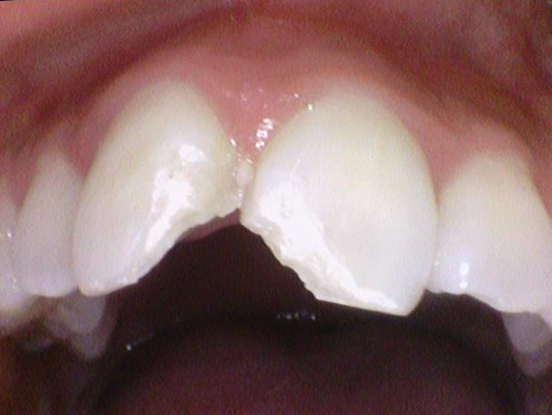 [광화문/연세예감치과] 앞니 치아가 파절되었다면? 앞니 부러짐.레진/크라운/임플란트 관련 이미지 6