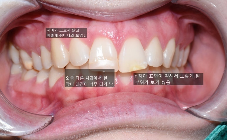 [서울역/을지로/치과] 본인이 옥니라고 생각한다면? 무삭제 라미네이트 어떤가요? 케이스 및 가격비용 관련 이미지 2