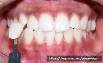 [서울시청역/광화문]치과에서 하는 원데이 치아미백, 연세예감치과에서 알려드려요 관련 이미지 5