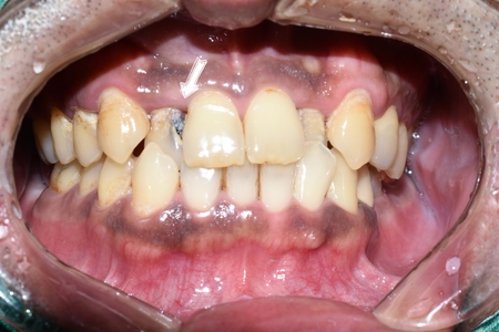 앞니가 너무 많이 썩었어요 앞니 충치치료 관련 이미지 6