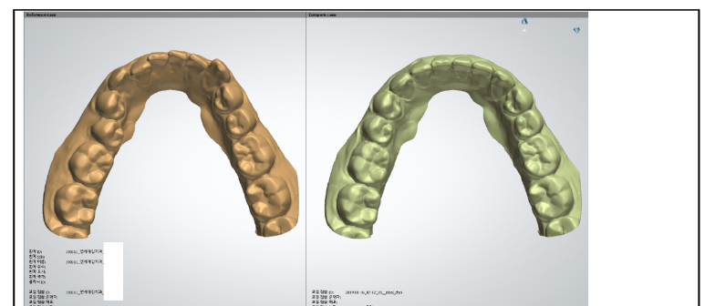 서울역 치과 투명교정 실제사례,비용가격 알아볼까요? 관련 이미지 4